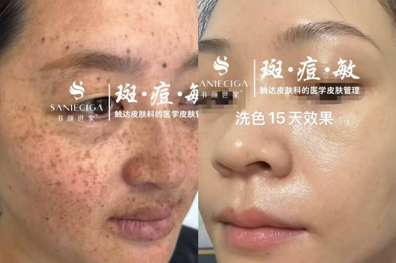 ✨ 15天焕肤新肌 #效果保障✨